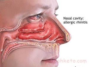رینیت آلرژیک
