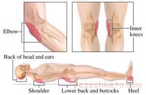 زخم بستر و درمان آن