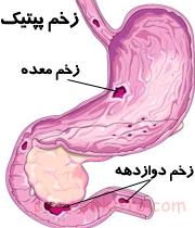 علائم زخم معده کدامند