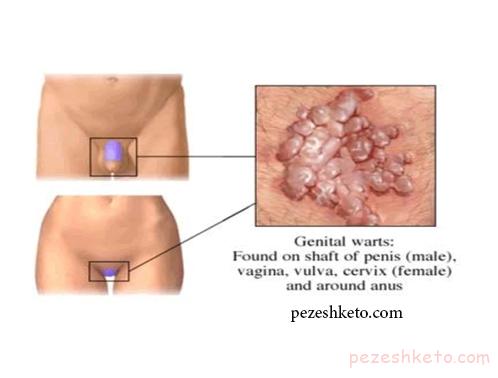 زگیل تناسلی چیست