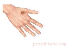 مقاله درباره زگیل