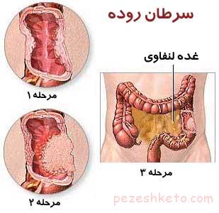 روش تشخیص سرطان روده