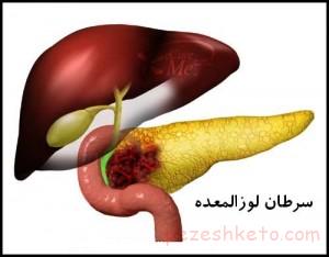 سرطان‌ لوزالمعده‌ چیست