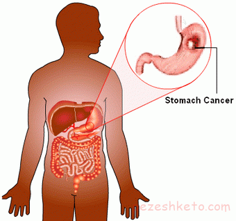اطلاعاتی درباره سرطان معده