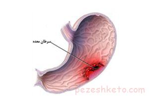 همه چیز درباره سرطان معده