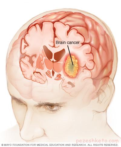 سرطان مغز چیست