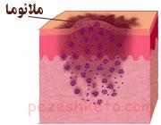 ابتلا به سرطان پوست در چه کسانی بیشتر است