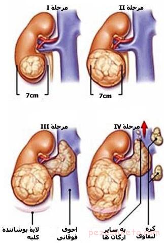 سرطان کلیه چیست