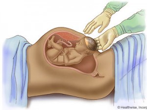 پیامد سزارین برای کودک