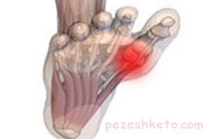 سزاموئیدیت