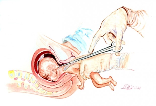 موارد مجاز سقط جنین