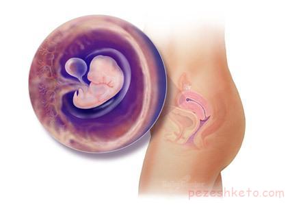 علل سقط جنین چیست