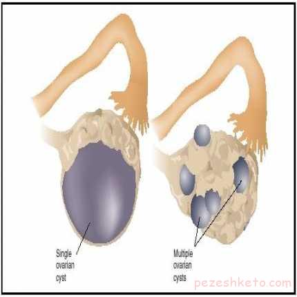 سندروم تحریک تخمدان ها