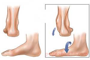 سندروم تونل تارس