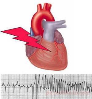غش قلبی چیست