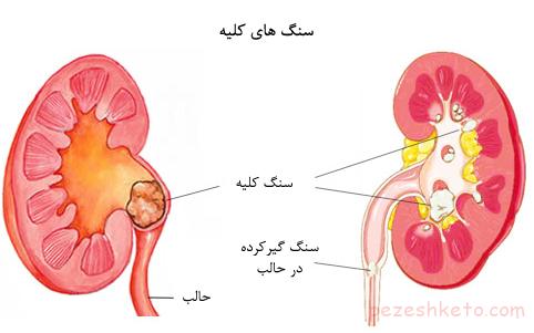 نشانه های سنگ ادراری چیست