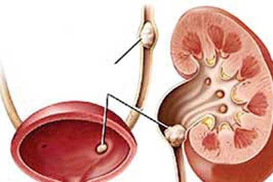 علت تشکیل سنگهای ادراری کلسیمی