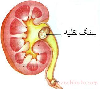 سنگ کلیه