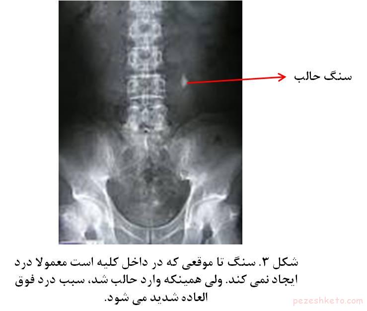 معرفی انواع سنگ کلیه
