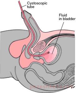 سیستوسکوپی چیست