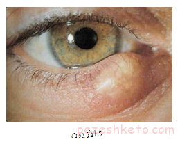 اطلاعاتی درباره شالازیون‌