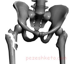 شکستگی استرسی لگن