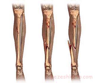 نکاتی در شکستگی باز استخوان