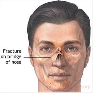 علل شکستگی بینی و درمان
