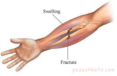 عوارض شکستگی ساعد چیست
