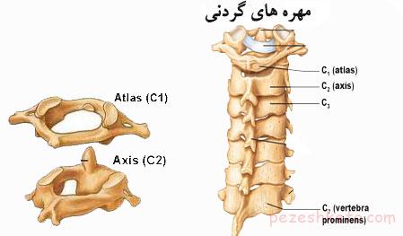 شکستگی مهره ها در ستون فقرات