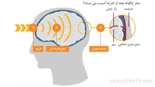 علائم ضربه مغزی چیست