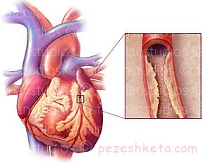 تنگی عروق کرونر در زنان چیست