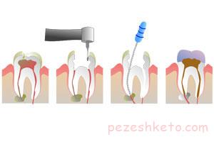 مراحل عصب کشی دندان