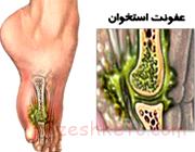 عفونت استخوان