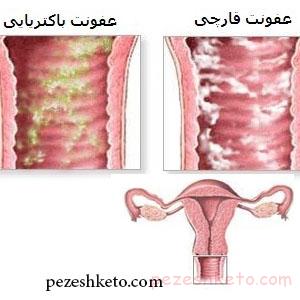 عفونت تناسلی در زنان