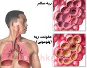 بیماری پنومونی چیست