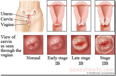 عفونت قارچی در دوران بارداری