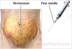 عفونت پرده صفاق داخل شکم
