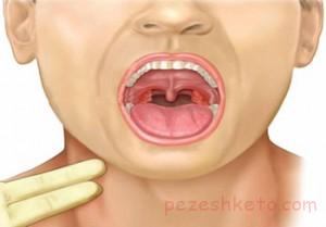 التهاب پنهان گلو