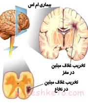 علائم ام اس چیست