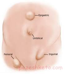 بیماری فتق و درمان فتق