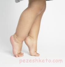 علل راه رفتن روی پنجه پا