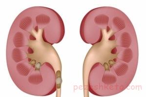 عمل PCNL چیست
