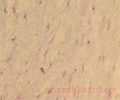 غضروف فیبری یا لیفی