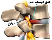 فتق دیسک کمر چیست