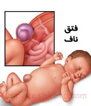 فتق ناف چیست