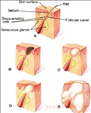 با جوشهای چرکی و دردناک چه کنیم