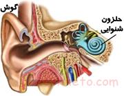 پروتز حلزون شنوایی