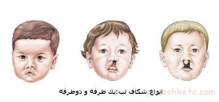 شکاف لب یا لب شکری چیست