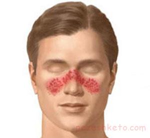 بیماری لوپوس چیست